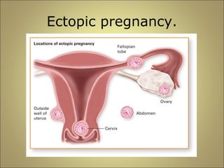 Ectopic pregnancy. 
 