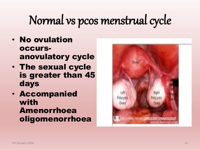 polycystic ovarian syndrome and general awareness