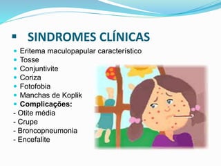  SINDROMES CLÍNICAS
 Eritema maculopapular característico
 Tosse
 Conjuntivite
 Coriza
 Fotofobia
 Manchas de Koplik
 Complicações:
- Otite média
- Crupe
- Broncopneumonia
- Encefalite
 
