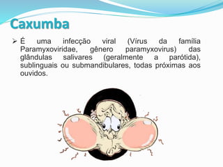 Caxumba
 É uma infecção viral (Vírus da família
Paramyxoviridae, gênero paramyxovirus) das
glândulas salivares (geralmente a parótida),
sublinguais ou submandibulares, todas próximas aos
ouvidos.
 