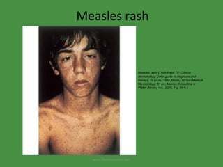 Measles rash Measles rash. (From Habif TP:  Clinical dermatology: Color guide to diagnosis and therapy,  St Louis, 1985, Mosby.) (From Medical Microbiology, 5 th  ed., Murray, Rosenthal & Pfaller, Mosby Inc., 2005, Fig. 59-6.) www.freelivedoctor.com 