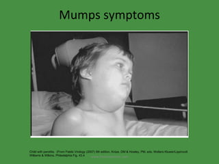 Mumps symptoms Child with parotitis.  (From Fields Vriology (2007) 5th edition, Knipe, DM & Howley, PM, eds, Wolters Kluwer/Lippincott Williams & Wilkins, Philadelphia Fig. 43.4 www.freelivedoctor.com 