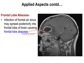 Applied Aspects contd…
Frontal Lobe Abscess-
• Infection of frontal air sinus
may spread posteriorly into
frontal lobe of brain causing
frontal lobe abscess.
Frontal air sinus
 