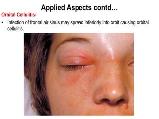 Applied Aspects contd…
Orbital Cellulitis-
• Infection of frontal air sinus may spread inferiorly into orbit causing orbital
cellulitis.
 