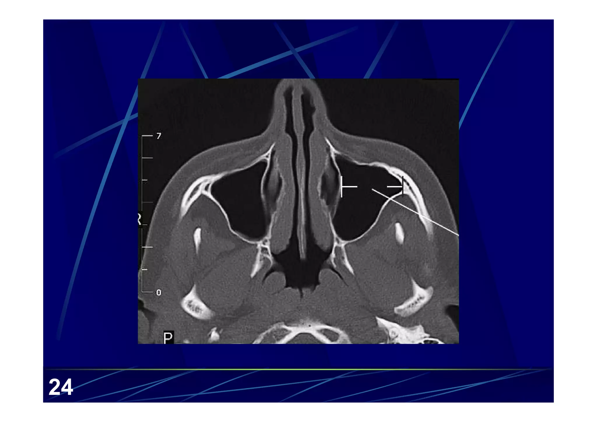 Sinus Scan Ct Anatomy Of The Paranasal Sinuses Paranasal Sinus CT, Coronal
