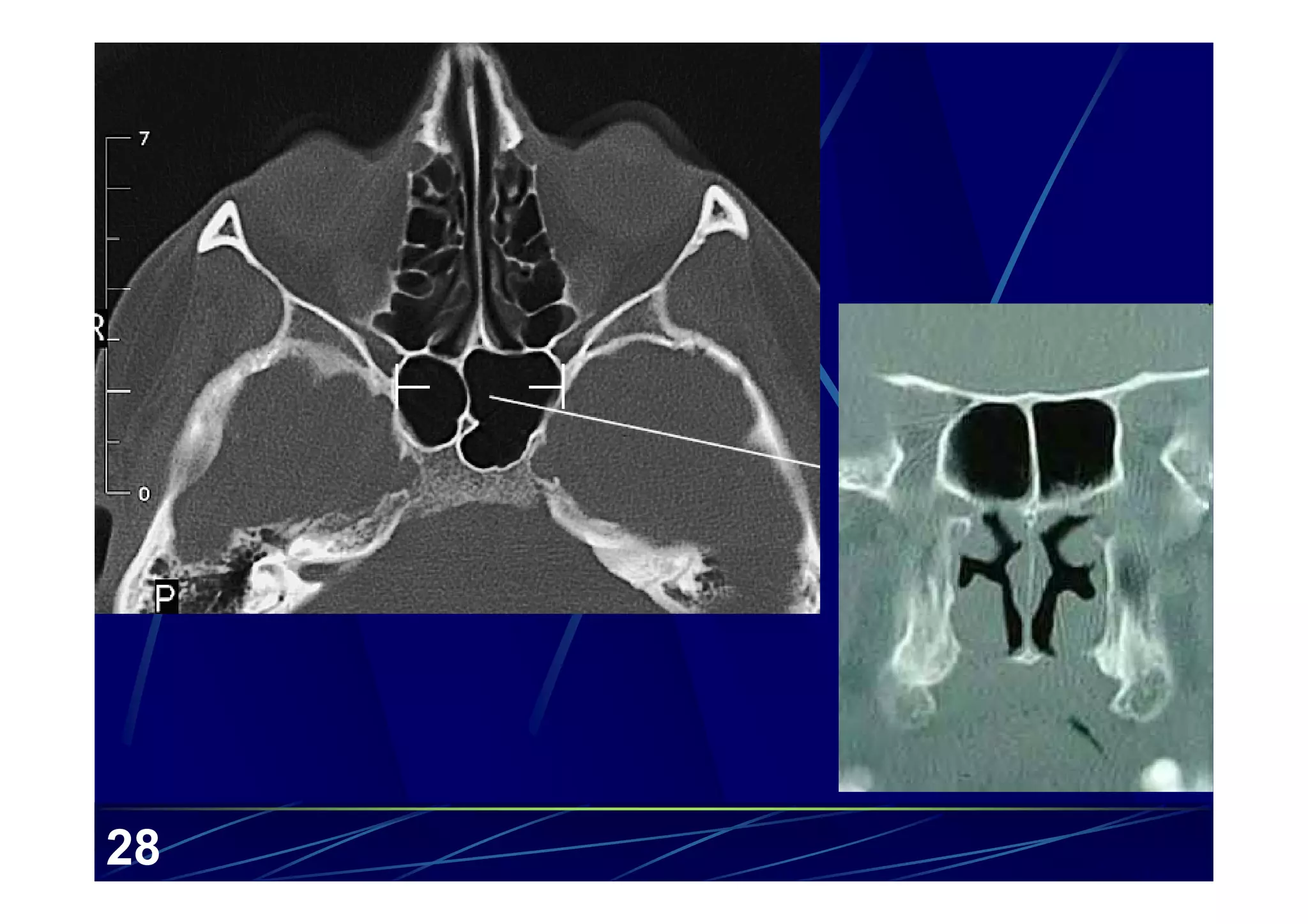 Sinus Scan CT anatomy of the paranasal sinuses | PDF