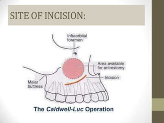 Testopel Incision Site Paranasal sinuses(ANATOMY) | PPTX