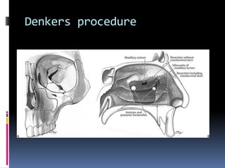 Paranasalsinuses | PDF