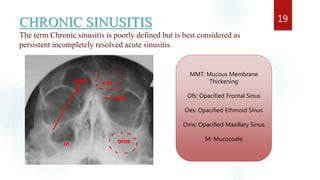 CHRONIC SINUSITIS
The term Chronic sinusitis is poorly defined but is best considered as
persistent incompletely resolved acute sinusitis.
19
MMT: Mucous Membrane
Thickening
Ofs: Opacified Frontal Sinus
Oes: Opacified Ethmoid Sinus
Oms: Opacified Maxillary Sinus
M: Mucocoele
 