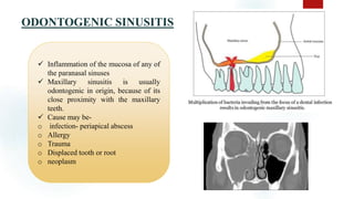 ODONTOGENIC SINUSITIS 21
 Inflammation of the mucosa of any of
the paranasal sinuses
 Maxillary sinusitis is usually
odontogenic in origin, because of its
close proximity with the maxillary
teeth.
 Cause may be-
o infection- periapical abscess
o Allergy
o Trauma
o Displaced tooth or root
o neoplasm
 