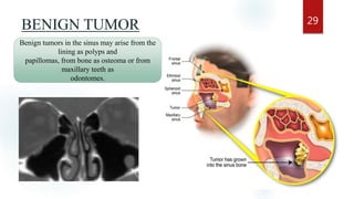 BENIGN TUMOR 29
Benign tumors in the sinus may arise from the
lining as polyps and
papillomas, from bone as osteoma or from
maxillary teeth as
odontomes.
 