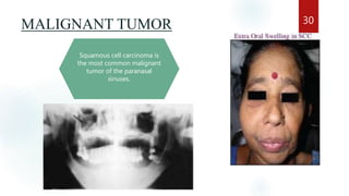 MALIGNANT TUMOR 30
Squamous cell carcinoma is
the most common malignant
tumor of the paranasal
sinuses.
 