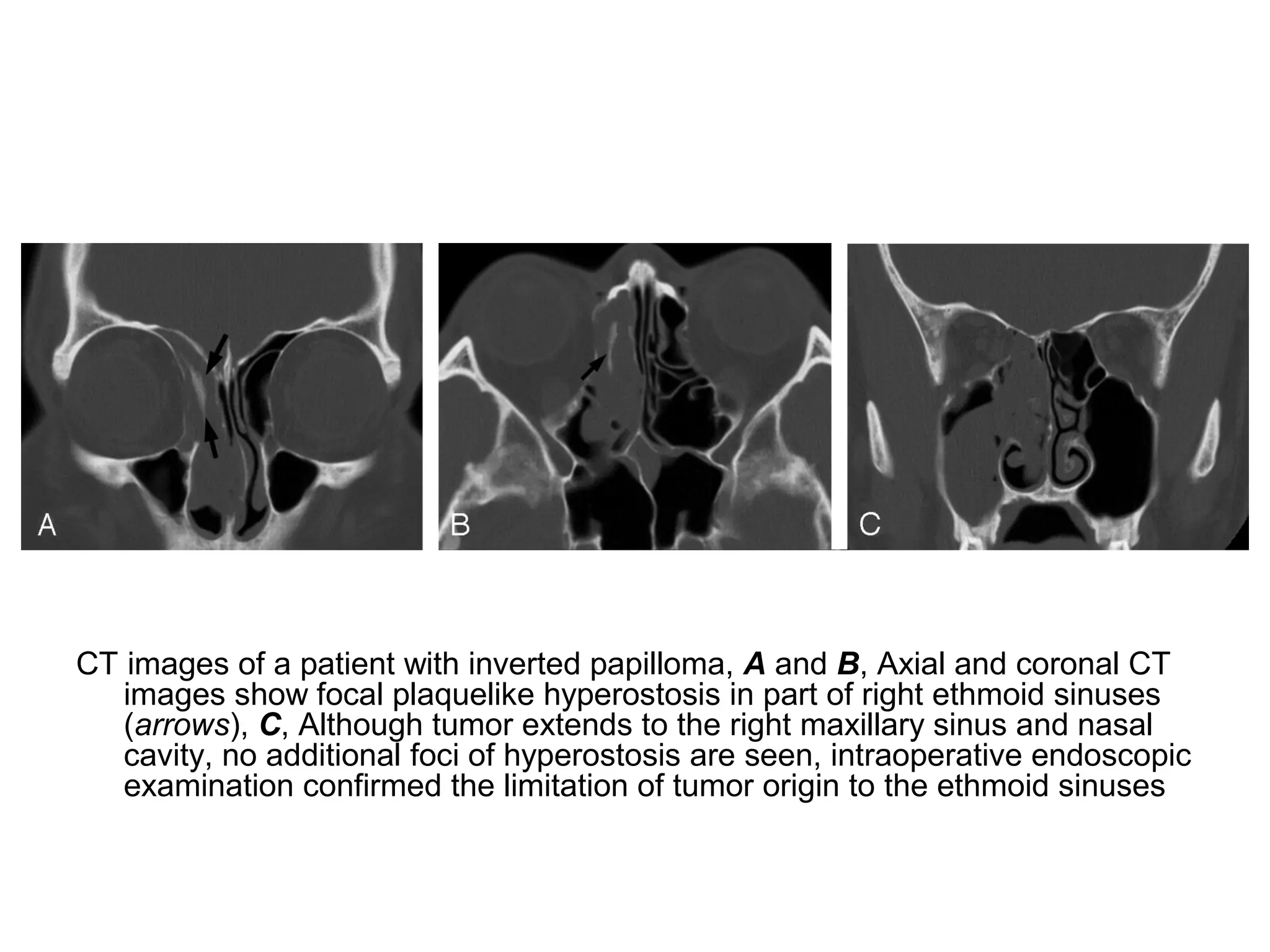 CT images of a patient with inverted papilloma, A and B, Axial and coronal CT
images show focal plaquelike hyperostosis in part of right ethmoid sinuses
(arrows), C, Although tumor extends to the right maxillary sinus and nasal
cavity, no additional foci of hyperostosis are seen, intraoperative endoscopic
examination confirmed the limitation of tumor origin to the ethmoid sinuses
 