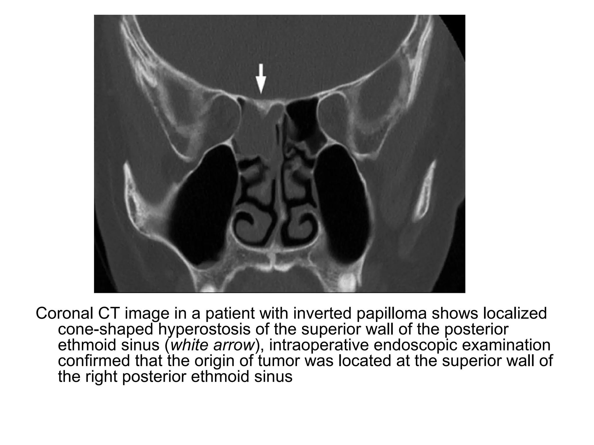 Coronal CT image in a patient with inverted papilloma shows localized
cone-shaped hyperostosis of the superior wall of the posterior
ethmoid sinus (white arrow), intraoperative endoscopic examination
confirmed that the origin of tumor was located at the superior wall of
the right posterior ethmoid sinus
 
