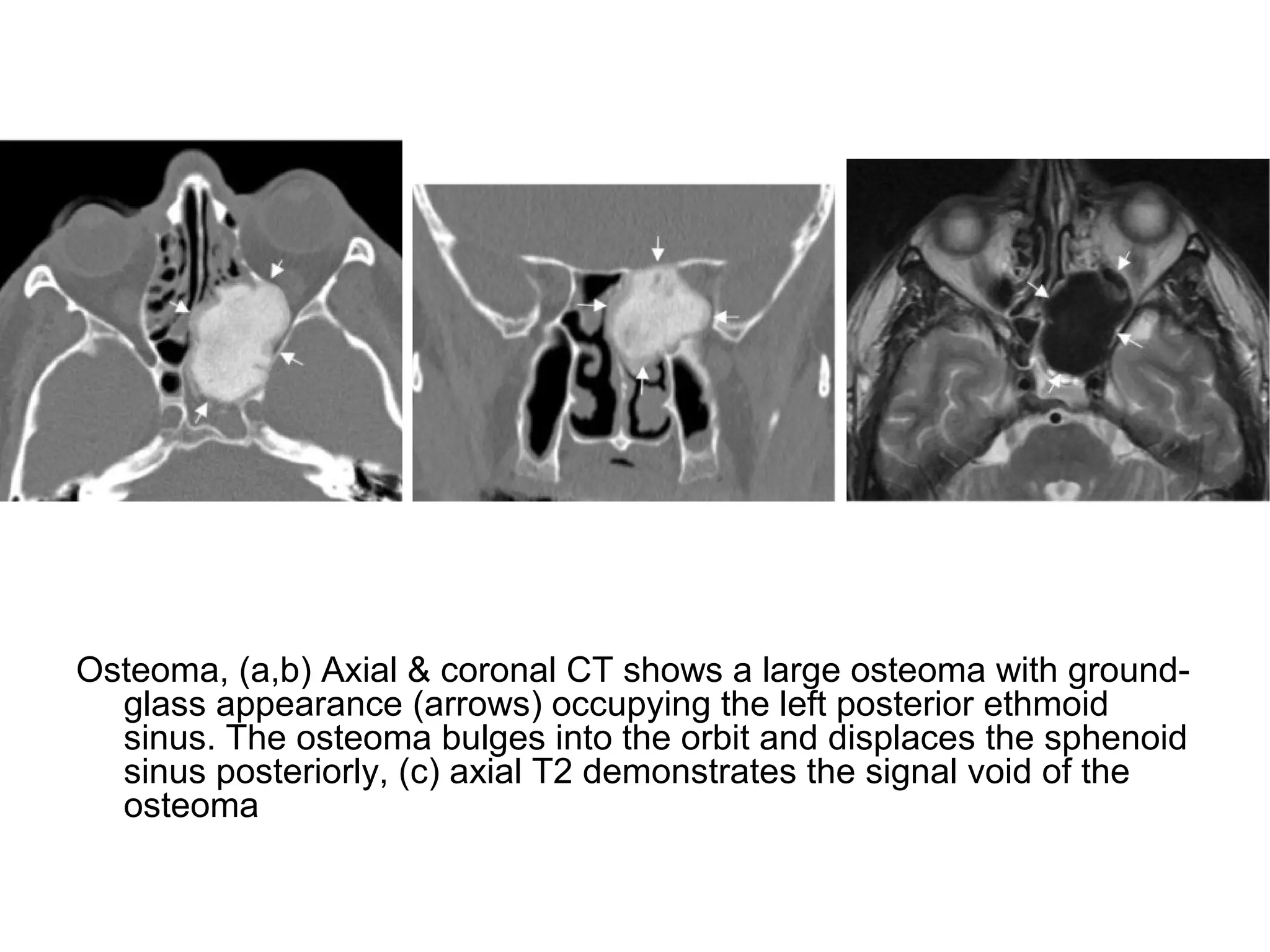 Osteoma, (a,b) Axial & coronal CT shows a large osteoma with ground-
glass appearance (arrows) occupying the left posterior ethmoid
sinus. The osteoma bulges into the orbit and displaces the sphenoid
sinus posteriorly, (c) axial T2 demonstrates the signal void of the
osteoma
 
