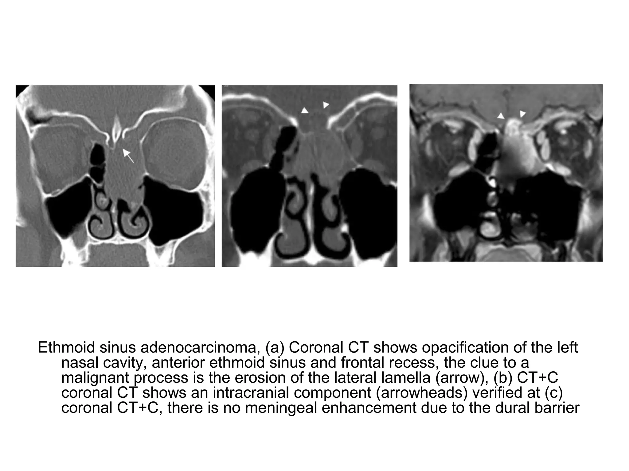 Ethmoid sinus adenocarcinoma, (a) Coronal CT shows opacification of the left
nasal cavity, anterior ethmoid sinus and frontal recess, the clue to a
malignant process is the erosion of the lateral lamella (arrow), (b) CT+C
coronal CT shows an intracranial component (arrowheads) verified at (c)
coronal CT+C, there is no meningeal enhancement due to the dural barrier
 