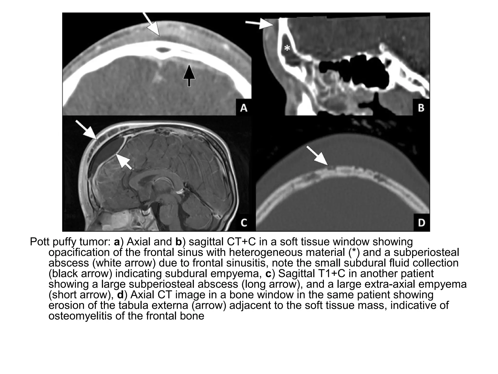 Pott puffy tumor: a) Axial and b) sagittal CT+C in a soft tissue window showing
opacification of the frontal sinus with heterogeneous material (*) and a subperiosteal
abscess (white arrow) due to frontal sinusitis, note the small subdural fluid collection
(black arrow) indicating subdural empyema, c) Sagittal T1+C in another patient
showing a large subperiosteal abscess (long arrow), and a large extra-axial empyema
(short arrow), d) Axial CT image in a bone window in the same patient showing
erosion of the tabula externa (arrow) adjacent to the soft tissue mass, indicative of
osteomyelitis of the frontal bone
 