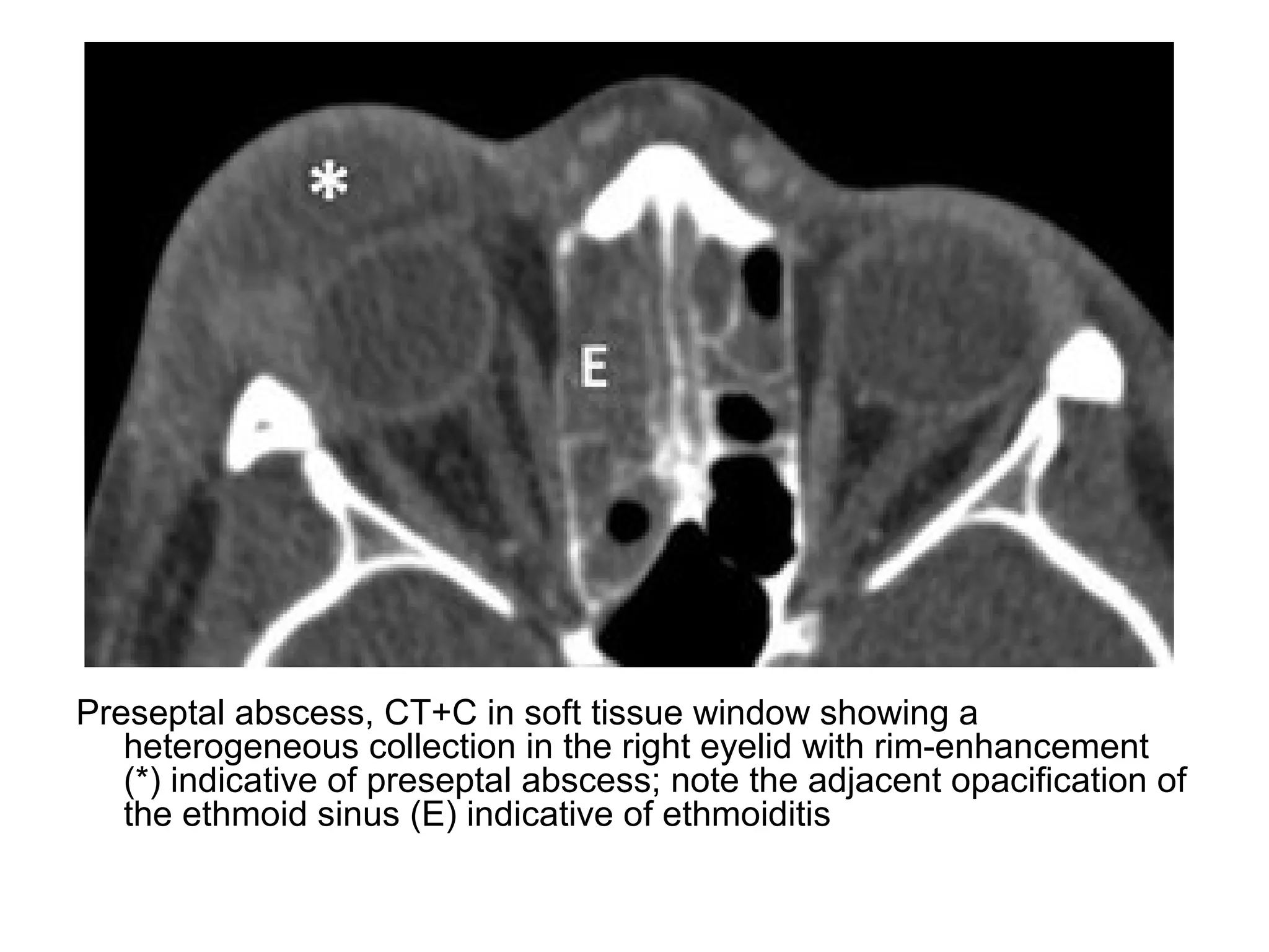 Preseptal abscess, CT+C in soft tissue window showing a
heterogeneous collection in the right eyelid with rim-enhancement
(*) indicative of preseptal abscess; note the adjacent opacification of
the ethmoid sinus (E) indicative of ethmoiditis
 