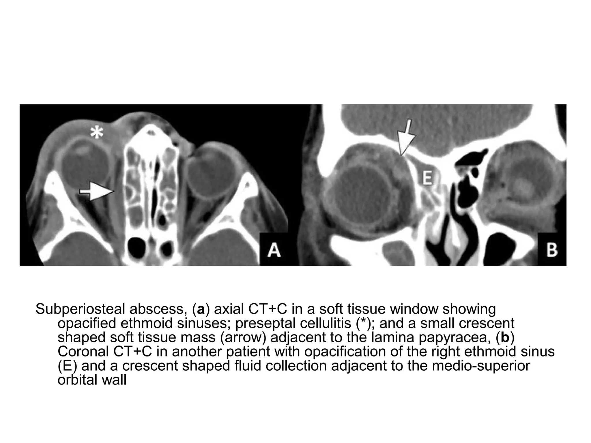 Subperiosteal abscess, (a) axial CT+C in a soft tissue window showing
opacified ethmoid sinuses; preseptal cellulitis (*); and a small crescent
shaped soft tissue mass (arrow) adjacent to the lamina papyracea, (b)
Coronal CT+C in another patient with opacification of the right ethmoid sinus
(E) and a crescent shaped fluid collection adjacent to the medio-superior
orbital wall
 