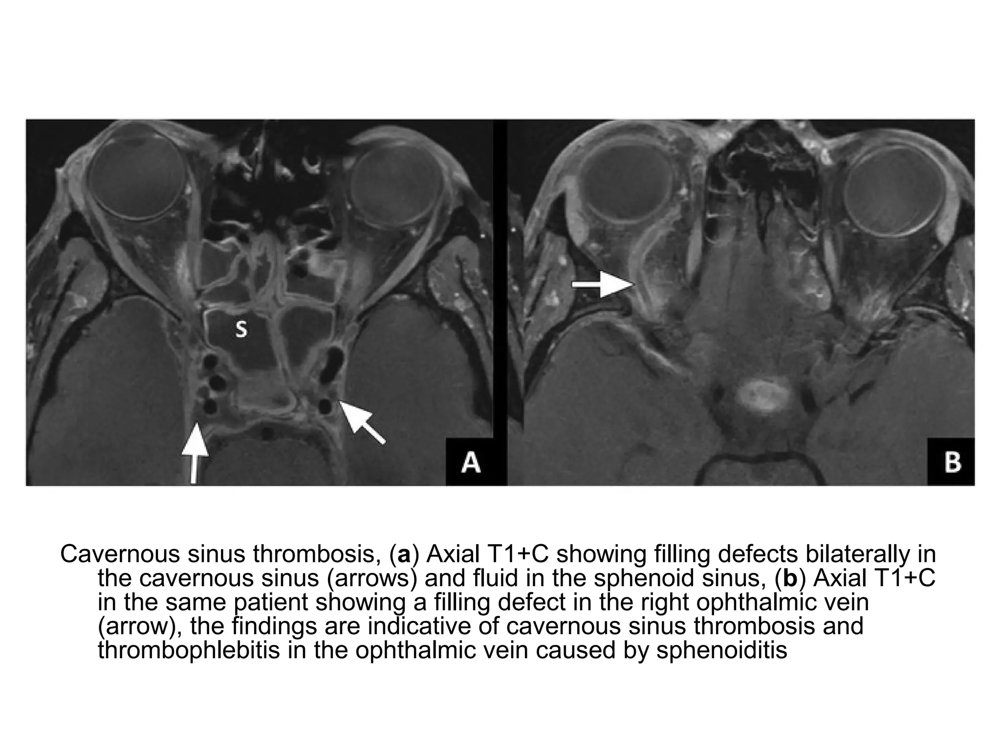 Cavernous sinus thrombosis, (a) Axial T1+C showing filling defects bilaterally in
the cavernous sinus (arrows) and fluid in the sphenoid sinus, (b) Axial T1+C
in the same patient showing a filling defect in the right ophthalmic vein
(arrow), the findings are indicative of cavernous sinus thrombosis and
thrombophlebitis in the ophthalmic vein caused by sphenoiditis
 
