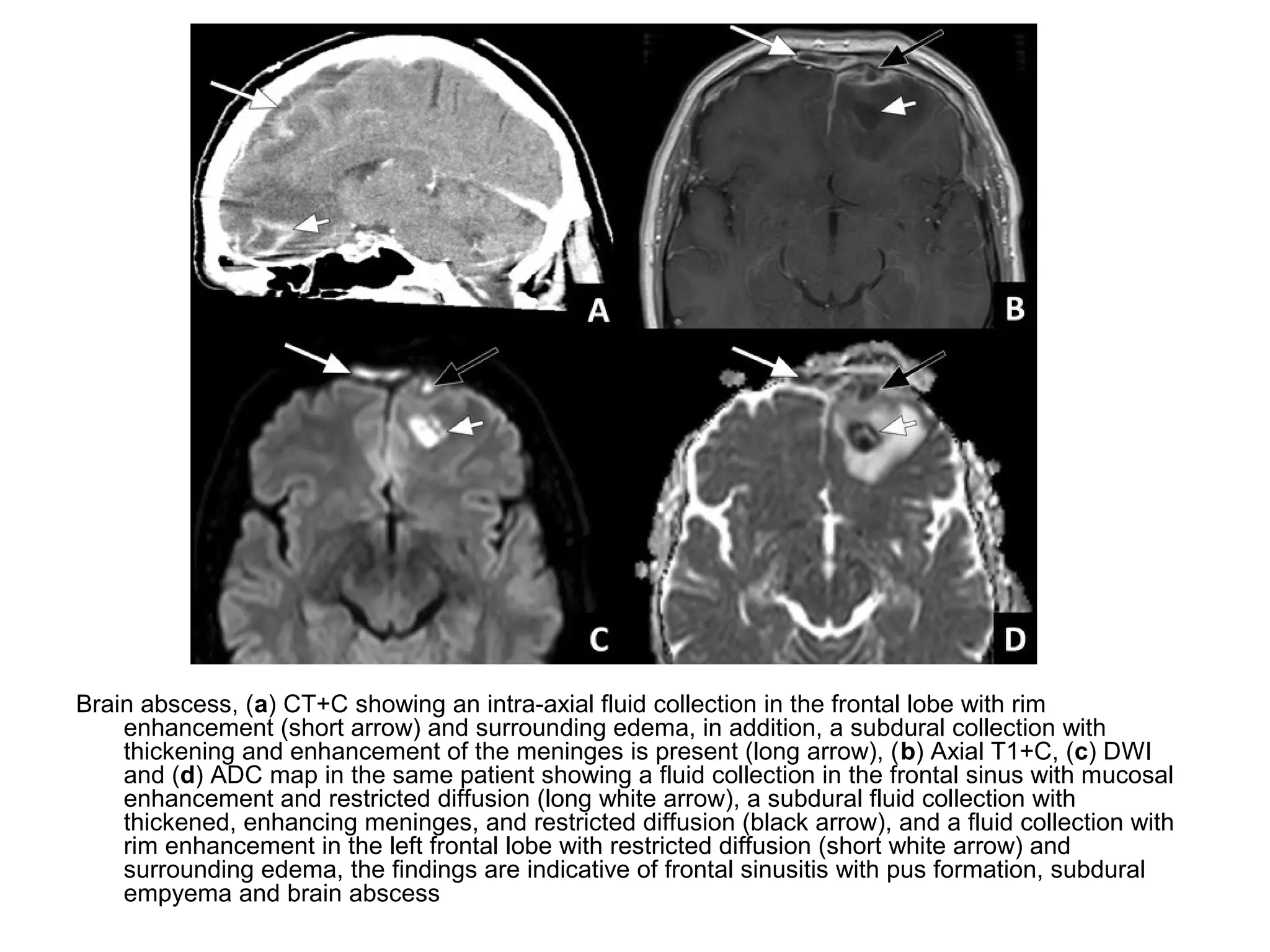 Brain abscess, (a) CT+C showing an intra-axial fluid collection in the frontal lobe with rim
enhancement (short arrow) and surrounding edema, in addition, a subdural collection with
thickening and enhancement of the meninges is present (long arrow), (b) Axial T1+C, (c) DWI
and (d) ADC map in the same patient showing a fluid collection in the frontal sinus with mucosal
enhancement and restricted diffusion (long white arrow), a subdural fluid collection with
thickened, enhancing meninges, and restricted diffusion (black arrow), and a fluid collection with
rim enhancement in the left frontal lobe with restricted diffusion (short white arrow) and
surrounding edema, the findings are indicative of frontal sinusitis with pus formation, subdural
empyema and brain abscess
 