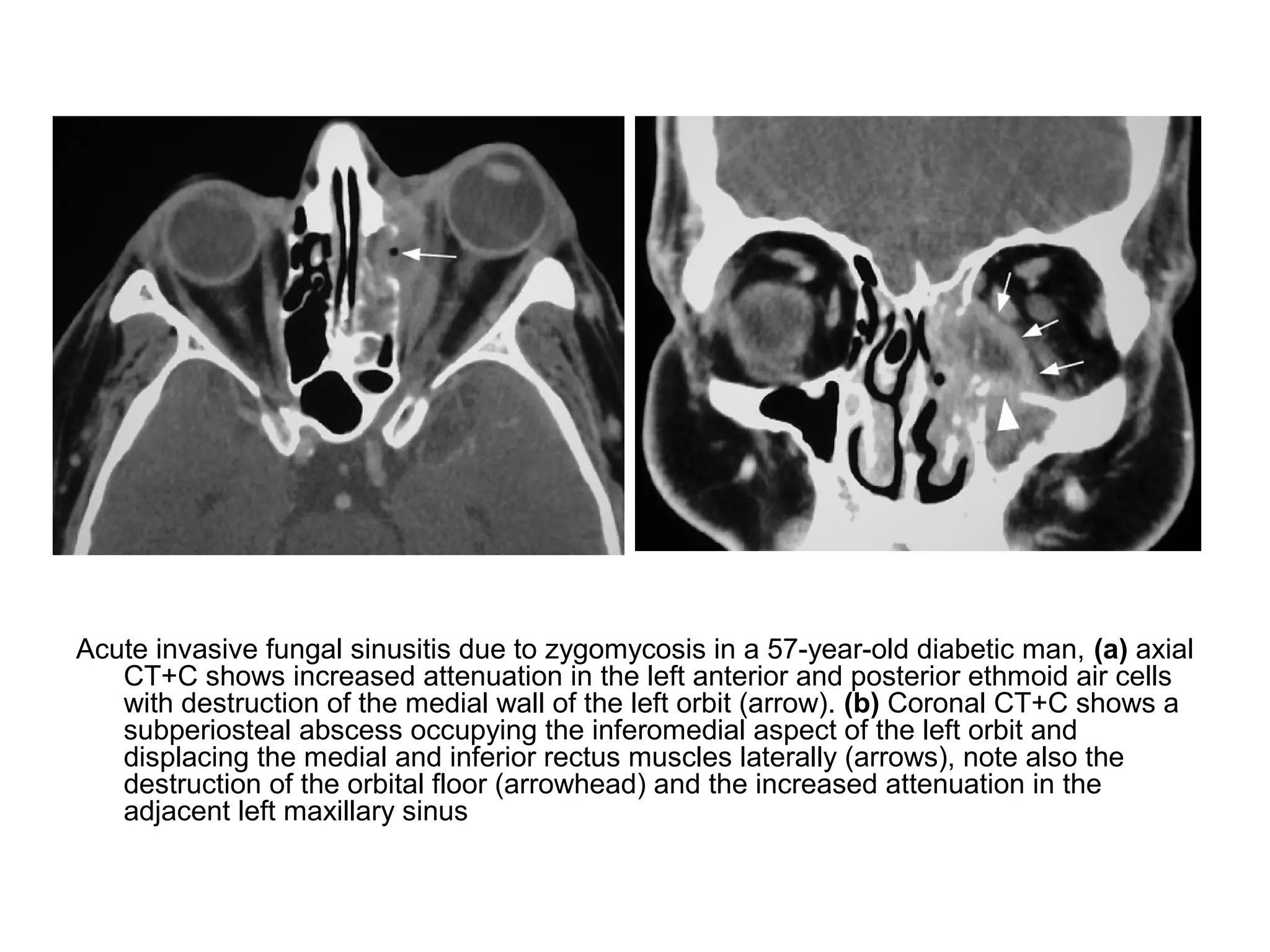 Acute invasive fungal sinusitis due to zygomycosis in a 57-year-old diabetic man, (a) axial
CT+C shows increased attenuation in the left anterior and posterior ethmoid air cells
with destruction of the medial wall of the left orbit (arrow). (b) Coronal CT+C shows a
subperiosteal abscess occupying the inferomedial aspect of the left orbit and
displacing the medial and inferior rectus muscles laterally (arrows), note also the
destruction of the orbital floor (arrowhead) and the increased attenuation in the
adjacent left maxillary sinus
 