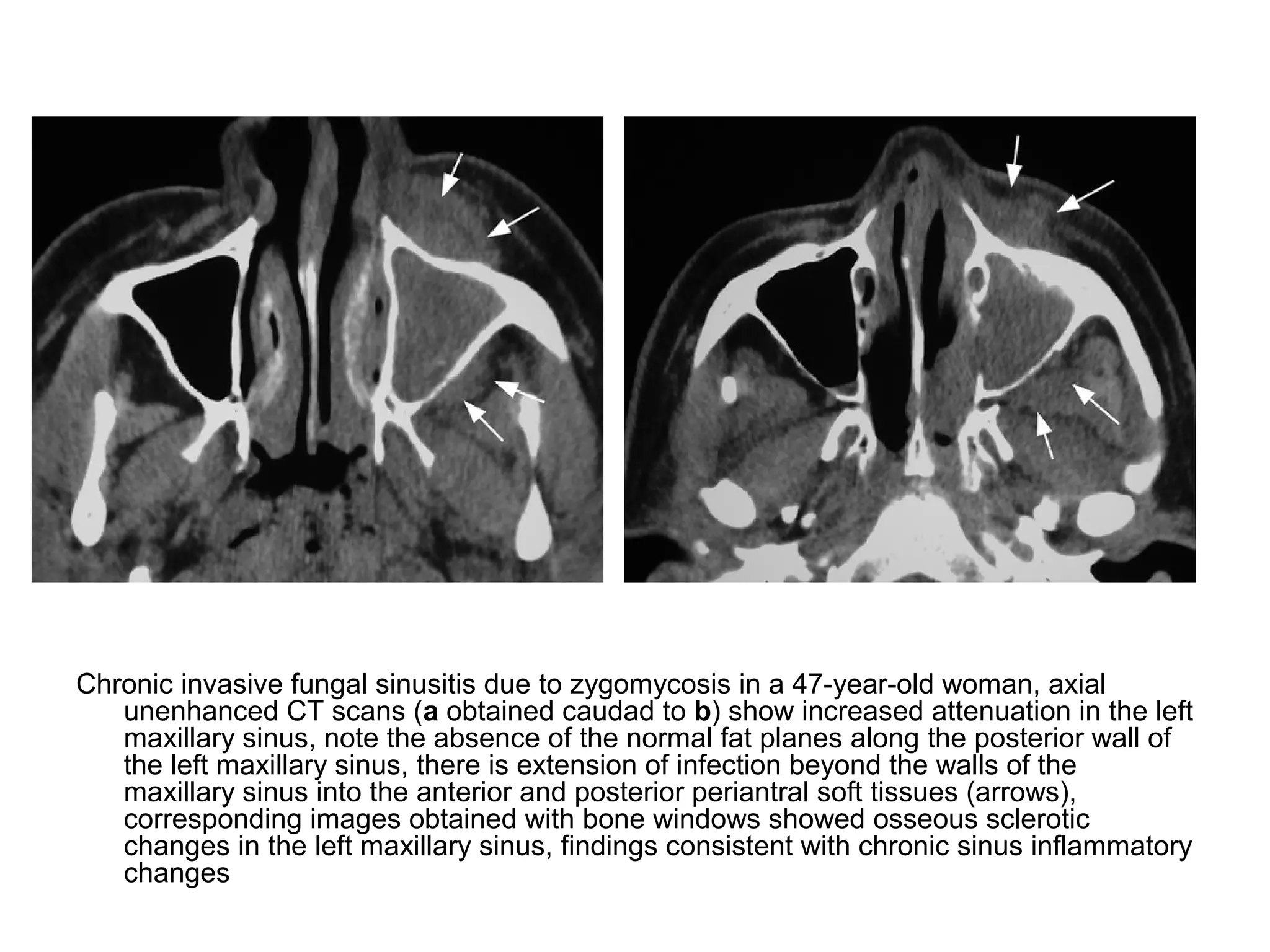 Chronic invasive fungal sinusitis due to zygomycosis in a 47-year-old woman, axial
unenhanced CT scans (a obtained caudad to b) show increased attenuation in the left
maxillary sinus, note the absence of the normal fat planes along the posterior wall of
the left maxillary sinus, there is extension of infection beyond the walls of the
maxillary sinus into the anterior and posterior periantral soft tissues (arrows),
corresponding images obtained with bone windows showed osseous sclerotic
changes in the left maxillary sinus, findings consistent with chronic sinus inflammatory
changes
 