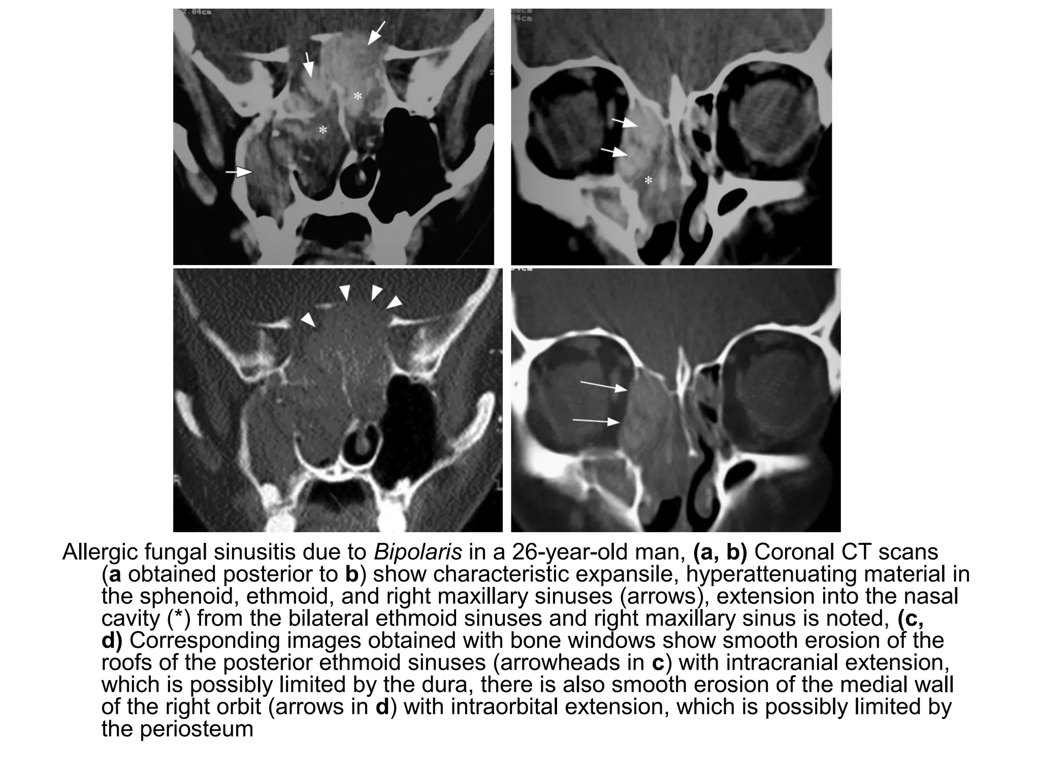 Allergic fungal sinusitis due to Bipolaris in a 26-year-old man, (a, b) Coronal CT scans
(a obtained posterior to b) show characteristic expansile, hyperattenuating material in
the sphenoid, ethmoid, and right maxillary sinuses (arrows), extension into the nasal
cavity (*) from the bilateral ethmoid sinuses and right maxillary sinus is noted, (c,
d) Corresponding images obtained with bone windows show smooth erosion of the
roofs of the posterior ethmoid sinuses (arrowheads in c) with intracranial extension,
which is possibly limited by the dura, there is also smooth erosion of the medial wall
of the right orbit (arrows in d) with intraorbital extension, which is possibly limited by
the periosteum
 