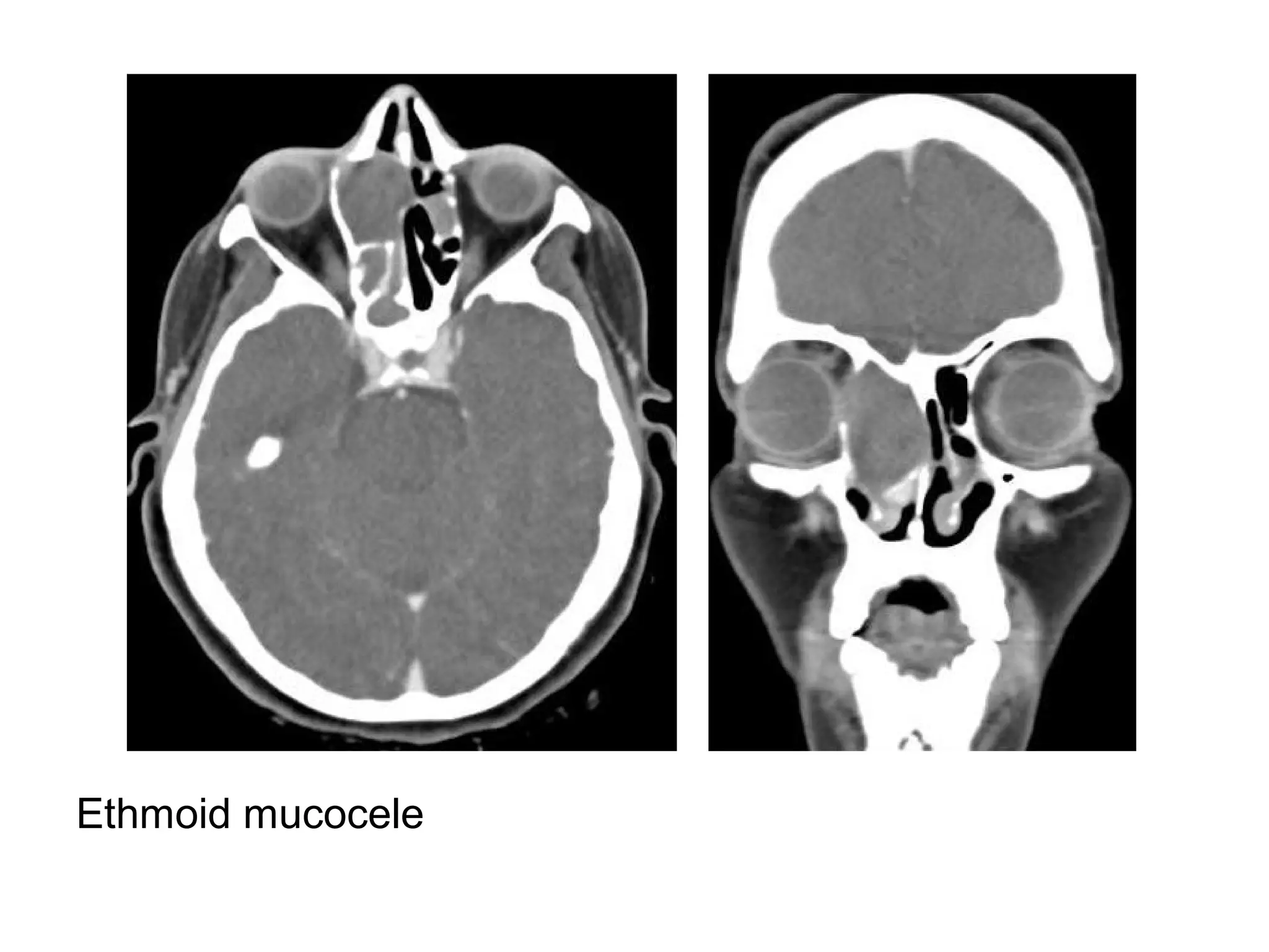 Ethmoid mucocele
 