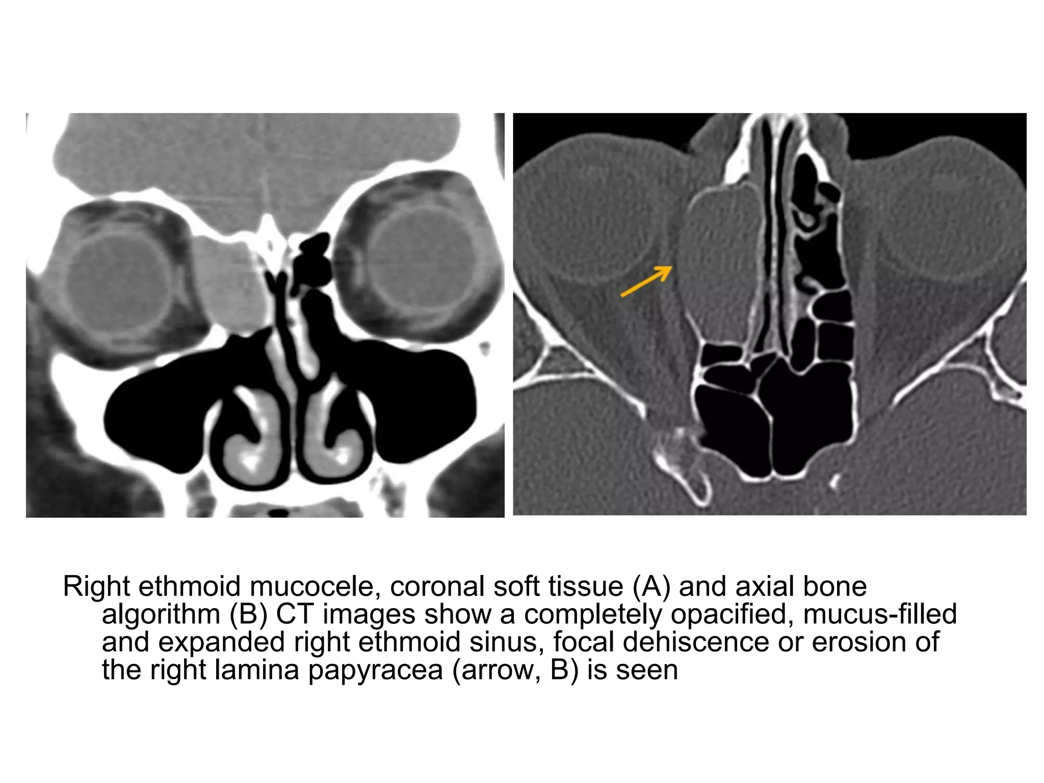Right ethmoid mucocele, coronal soft tissue (A) and axial bone
algorithm (B) CT images show a completely opacified, mucus-filled
and expanded right ethmoid sinus, focal dehiscence or erosion of
the right lamina papyracea (arrow, B) is seen
 