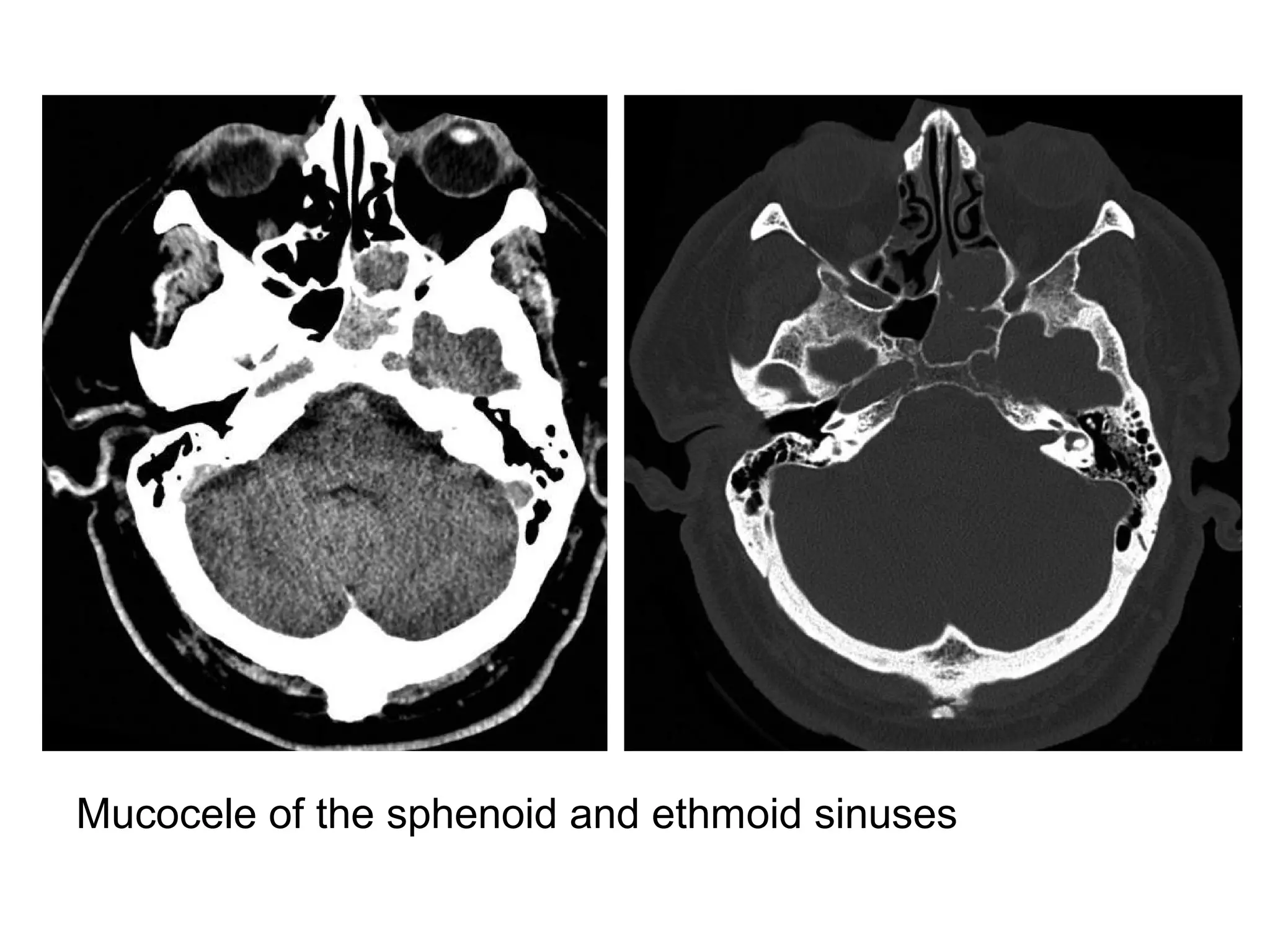 Mucocele of the sphenoid and ethmoid sinuses
 