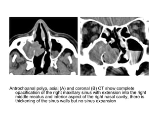 Diagnostic Imaging of Paranasal sinuses and Nose | PPT
