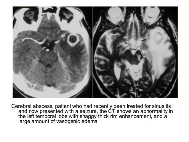 Diagnostic Imaging Of Paranasal Sinuses And Nose - 