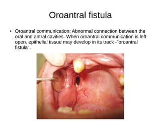 Oroantral fistula
● Oroantral communication: Abnormal connection between the
oral and antral cavities. When oroantral communication is left
open, epithelial tissue may develop in its track -"oroantral
fistula".
 