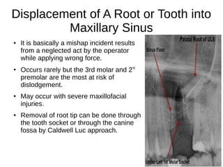Displacement of A Root or Tooth into
Maxillary Sinus
● It is basically a mishap incident results
from a neglected act by the operator
while applying wrong force.
●
Occurs rarely but the 3rd molar and 2nd
premolar are the most at risk of
dislodgement.
● May occur with severe maxillofacial
injuries.
● Removal of root tip can be done through
the tooth socket or through the canine
fossa by Caldwell Luc approach.
 