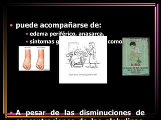   puede acompañarse de:  edema periférico, anasarca. síntomas gastrointestinales, como diarrea A pesar de las disminuciones de concentraciones de las globulinas, los enfermos no suelen presentar infecciones oportunistas o con coagulopatías. 