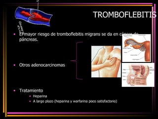 TROMBOFLEBITIS El mayor riesgo de tromboflebitis migrans se da en cáncer de páncreas. Otros adenocarcinomas Tratamiento Heparina A largo plazo (heparina y warfarina poco satisfactorio) 