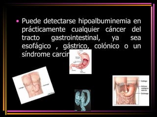 Puede detectarse hipoalbuminemia en prácticamente cualquier cáncer del tracto gastrointestinal, ya sea esofágico , gástrico, colónico o un síndrome carcinoide. 