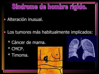 Alteración inusual. Los tumores más habitualmente implicados: * Cáncer de mama. * CMCP. * Timoma. Síndrome de hombre rígido. 