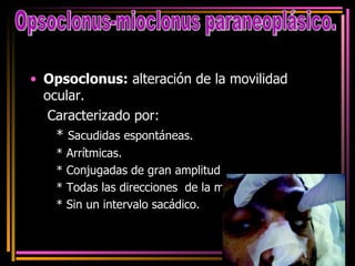 Opsoclonus:  alteración de la movilidad ocular.  Caracterizado por: *  Sacudidas espontáneas.  * Arrítmicas. * Conjugadas de gran amplitud * Todas las direcciones  de la mirada  * Sin un intervalo sacádico. Opsoclonus-mioclonus paraneoplásico. 
