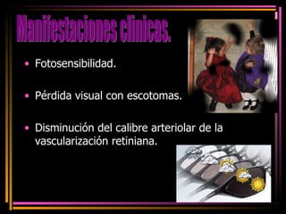 Fotosensibilidad. Pérdida visual con escotomas. Disminución del calibre arteriolar de la vascularización retiniana. Manifestaciones clinicas. 
