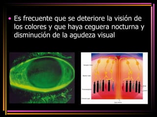 Es frecuente que se deteriore la visión de los colores y que haya ceguera nocturna y disminución de la agudeza visual  