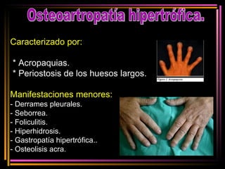 Osteoartropatía hipertrófica. Caracterizado por: * Acropaquias. * Periostosis de los huesos largos. Manifestaciones menores: - Derrames pleurales. - Seborrea. - Foliculitis. - Hiperhidrosis. - Gastropatía hipertrófica.. - Osteolisis acra. 