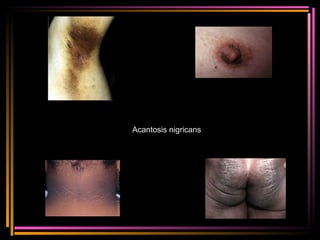 Acantosis nigricans 