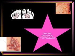 LESIONES  AMPOLLOSAS  Y URTICARIALES 