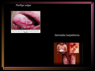 Penfigo vulgar Dermatitis herpetiforme 