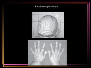 Paquidermoperiostosis  