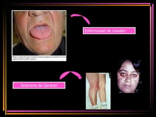 Enfermedad de cowden  Sindrome de Gardner 