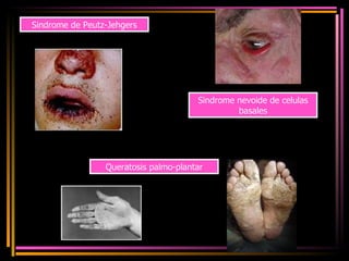 Sindrome de Peutz-Jehgers Queratosis palmo-plantar Sindrome nevoide de celulas basales 