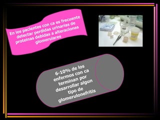 En los pacientes con ca es frecuente detectar perdidas urinarias de proteinas debidas a alteraciones glomerulares 6-10% de los enfermos con ca terminan por desarrollar algun tipo de glomerulonefritis 